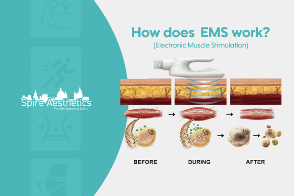 EMS treatment for post pregnancy weight loss treatment Herne