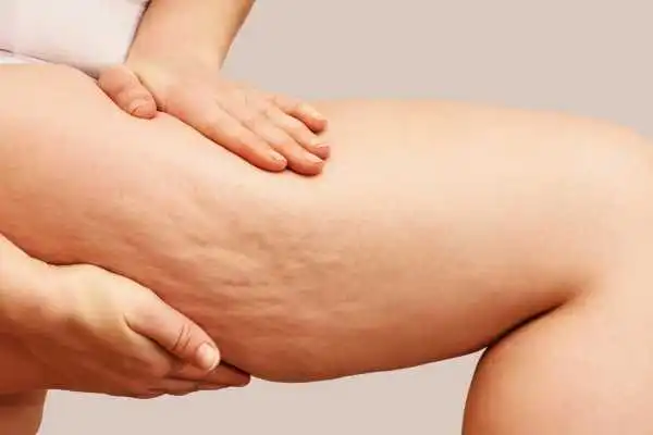 Image of woman showing leg with cellulite Herne