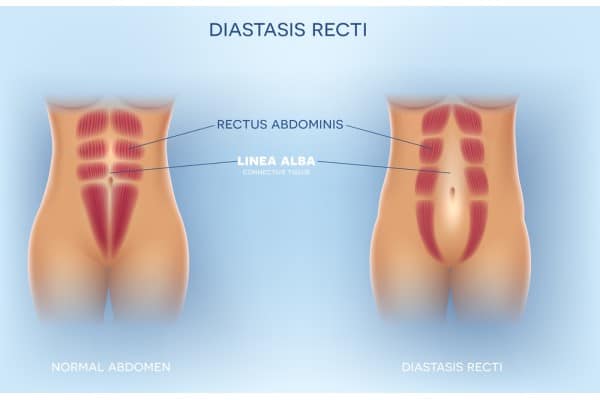 What Non-Surgical Options Are Available for Diastasis Recti Herne?