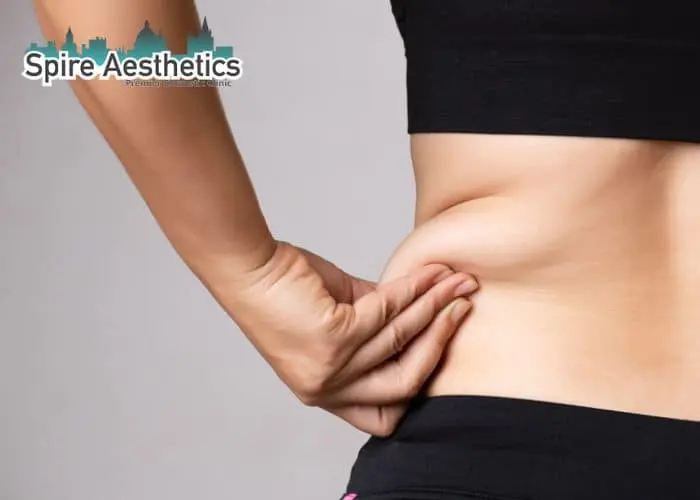 Image of woman pinching fat on their hips Herne. Fat Freezing treatment