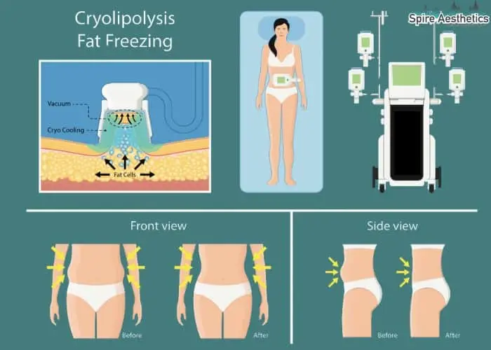 Fat freezing treatment Herne benefits for competitions to remove stubborn fat deposits.