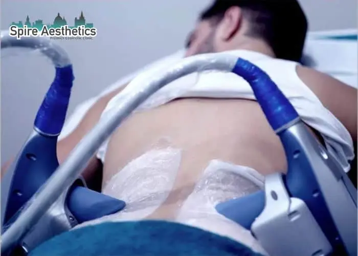 Man having fat freezing treatment done on love handles before a competitions Herne to create a sculpted look.