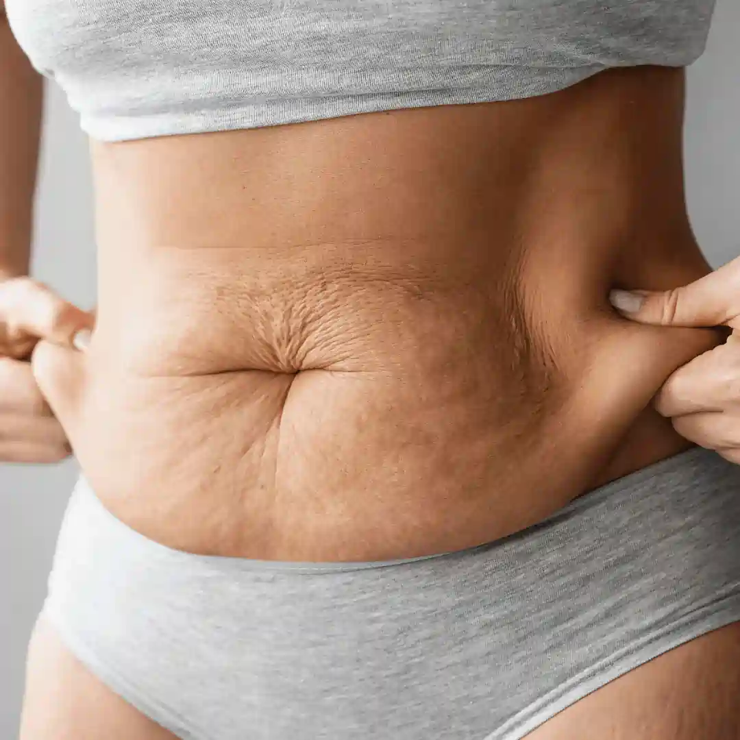 Is It Normal to Have Loose Skin After Pregnancy Herne?