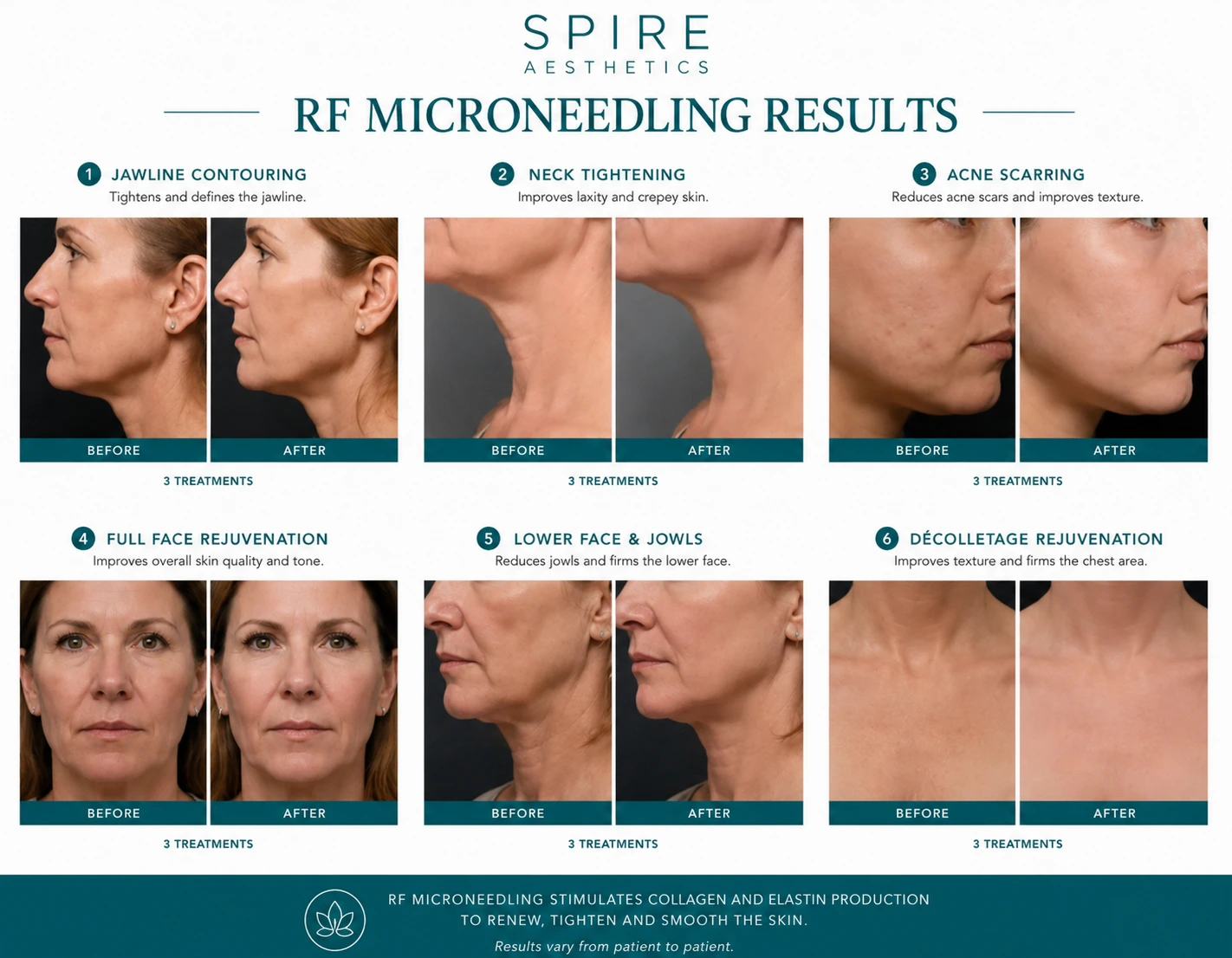 RF Microneedling Skin tightening Herne results