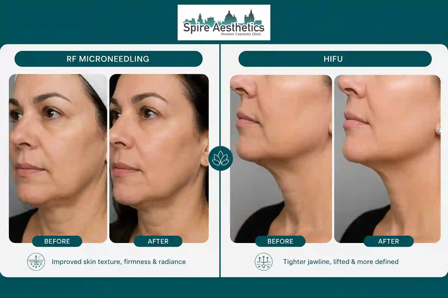 Can RF Microneedling and HIFU Be Combined Herne?