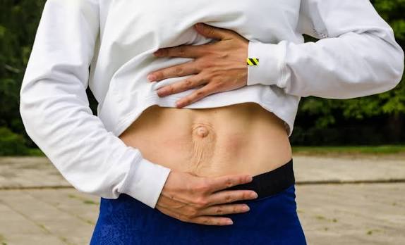 When Could Diastasis Recti Be the Missing Piece of the Puzzle Herne?