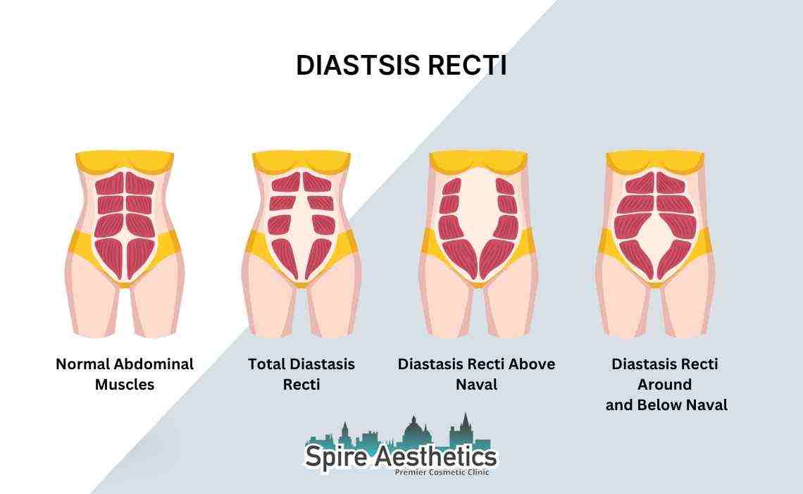 Is Non-Surgical Diastasis Recti Treatment Right for You? Common Concerns Answered Herne